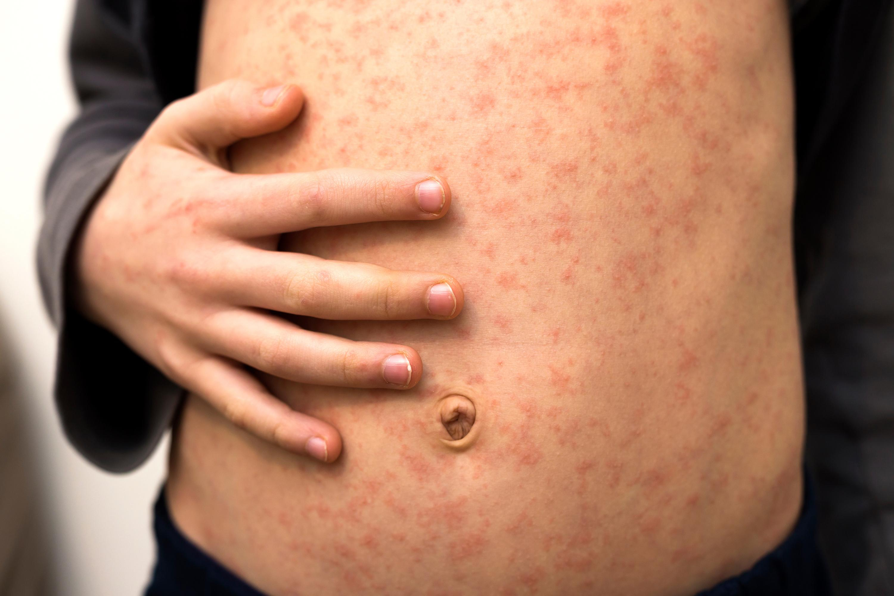 Thirty times more cases of measles in 2023 in Europe, WHO calls for urgent measures