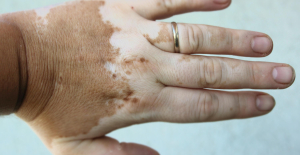 A first treatment for vitiligo available in France