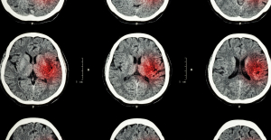 Stroke: a new antibody could increase patient survival